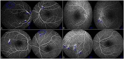 Case report: 3D intracranial vessel wall MRI in Susac syndrome: potential relevance for diagnosis and therapeutic management